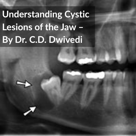 Understanding Cystic Lesions of the Jaw – By Dr. C.D. Dwivedi | Amrit Maxillofacial and Dental Clinic, Varanasi