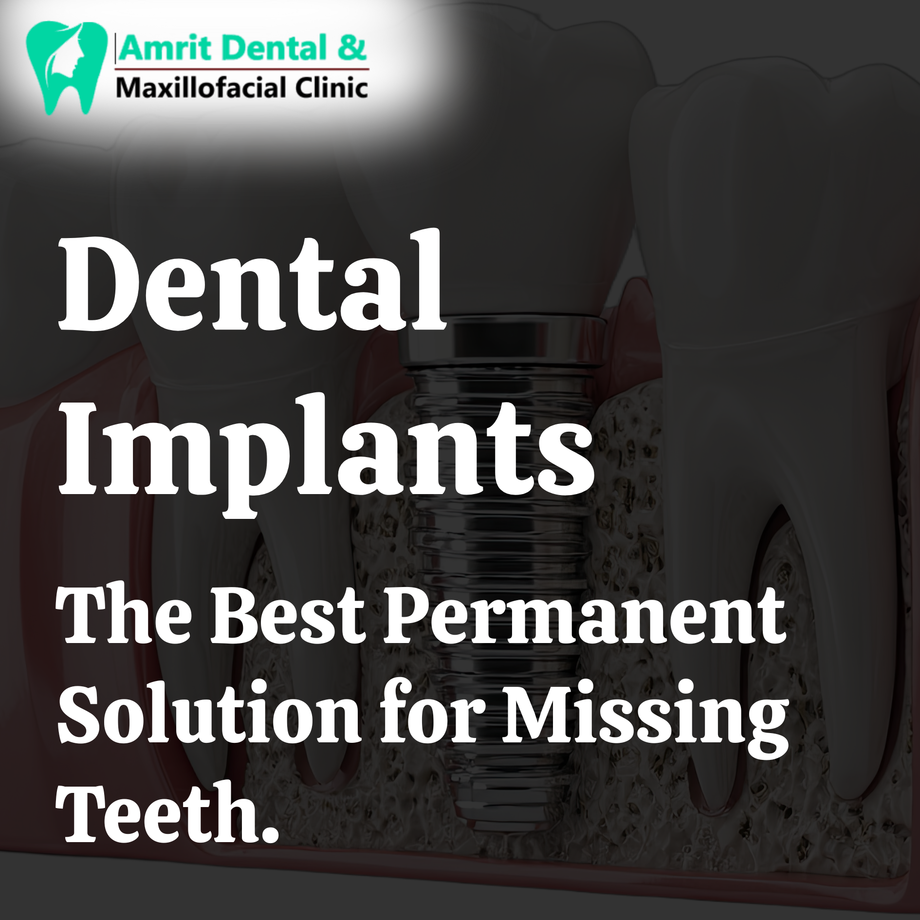 Dental Implants