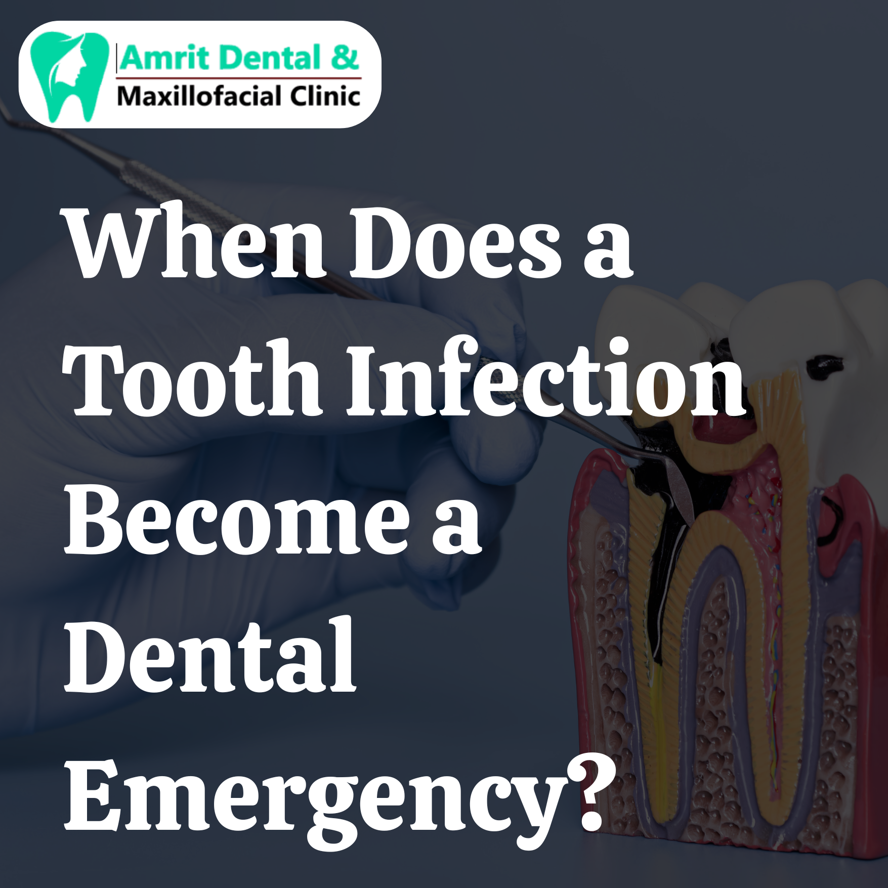 When Does a Tooth Infection Become a Dental Emergency?