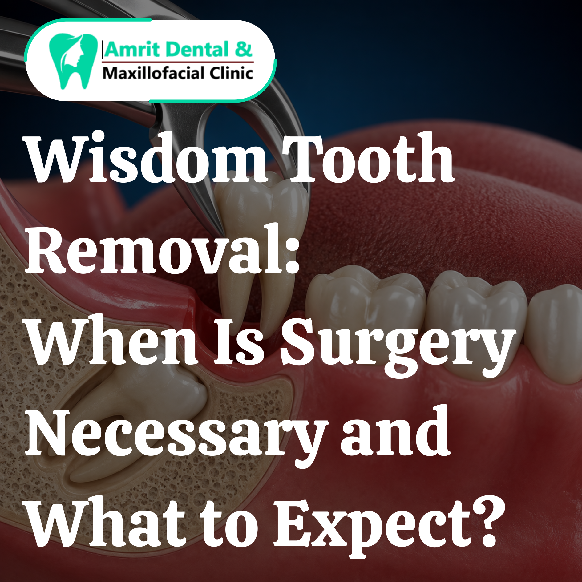 Wisdom Tooth Removal: When Is Surgery Necessary and What to Expect?