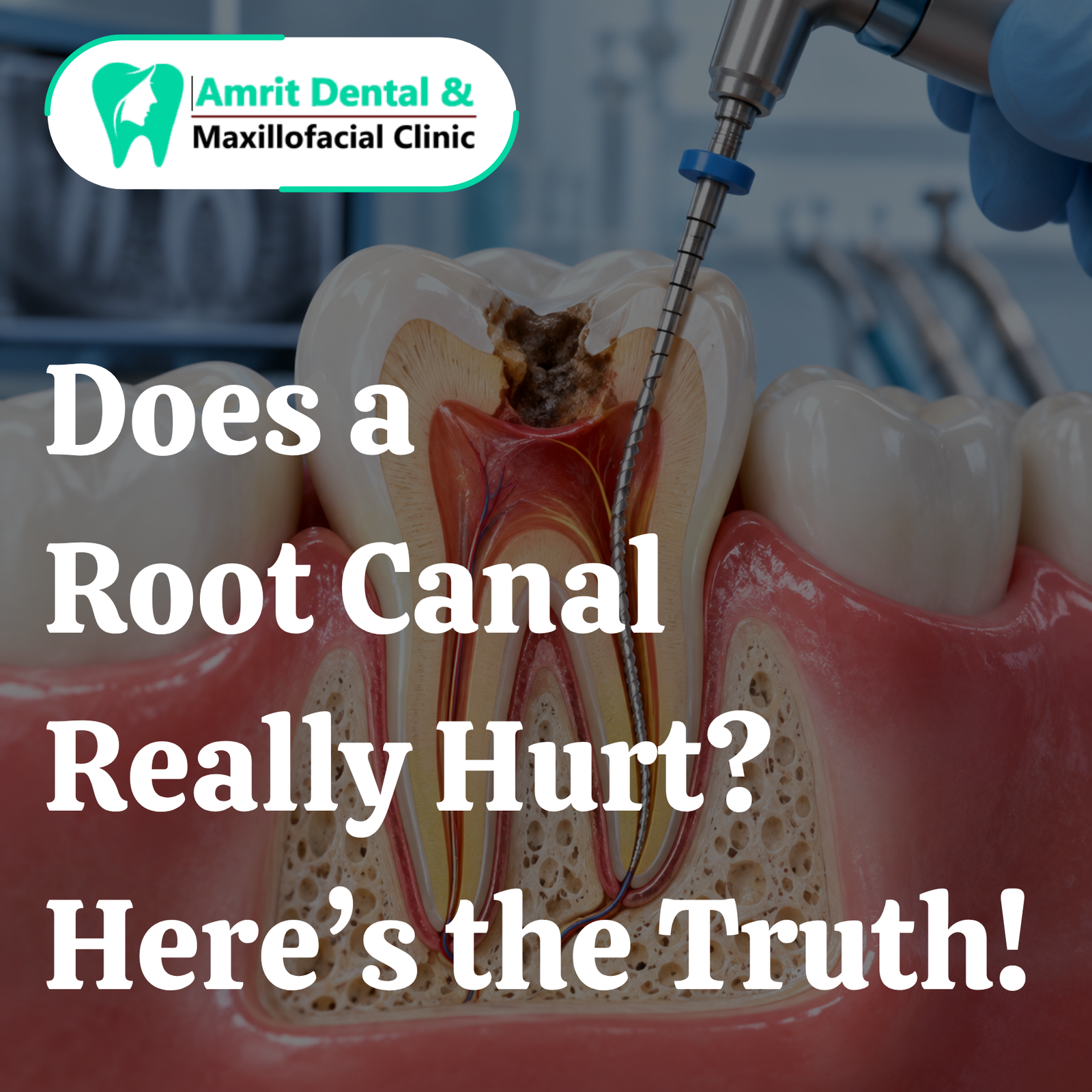 Does Root Canal Treatment Hurt? What Patients Should Know