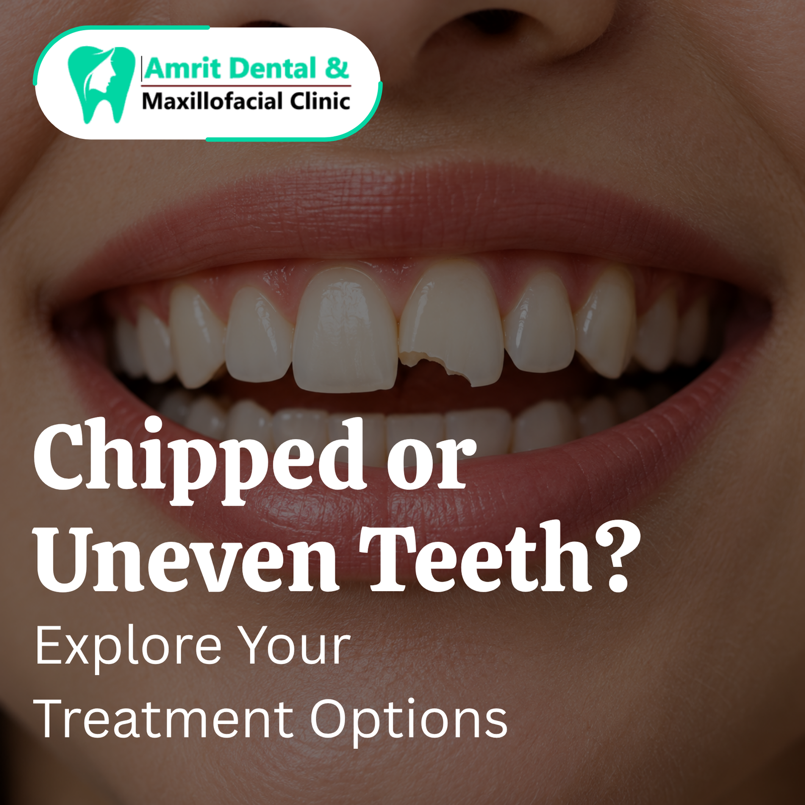 Chipped or Uneven Teeth? Explore Your Treatment Options