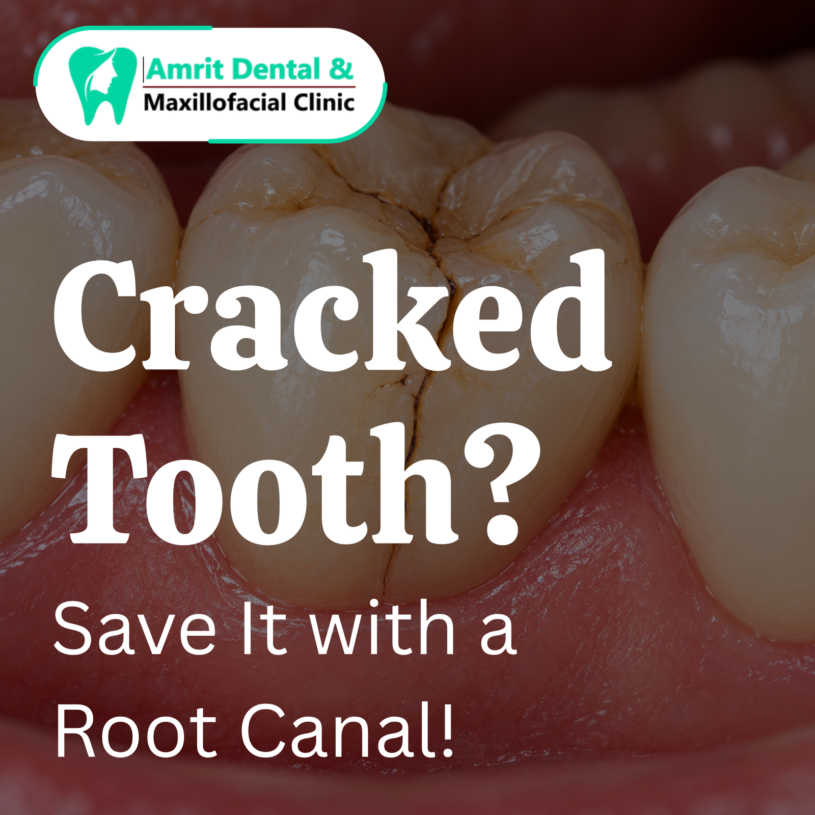 Cracked Tooth: Can It Be Saved with Root Canal Treatment?