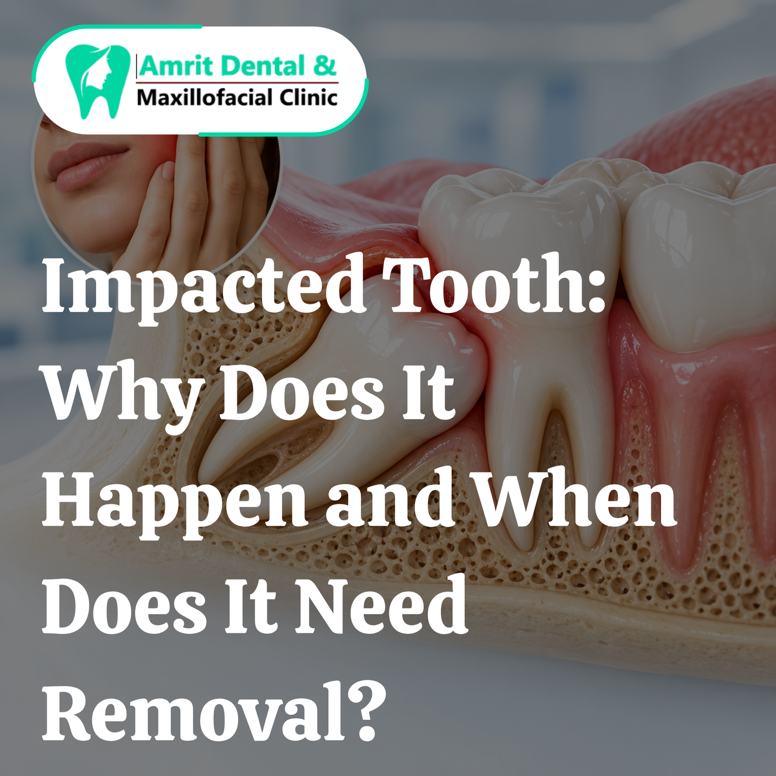 Impacted Tooth: Why Does It Happen and When Does It Need Removal?